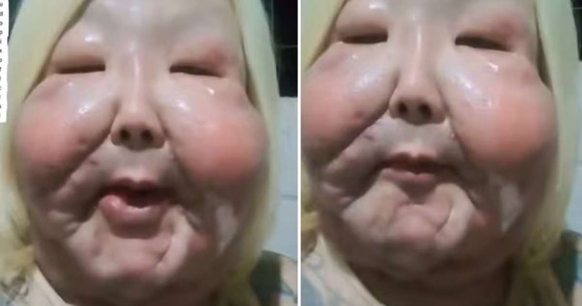 Juju do Pix enfrenta problema em cicatriz após cirurgia para remover óleo mineral do rosto