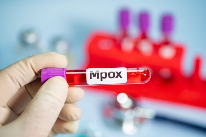 O caso de mpox foi o segundo do clado 1b no Estado -  (crédito: EdiCase)