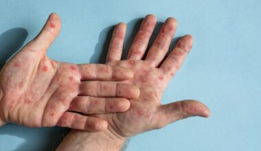 Segundo caso de nova cepa de mpox é confirmado no Estado de São Paulo