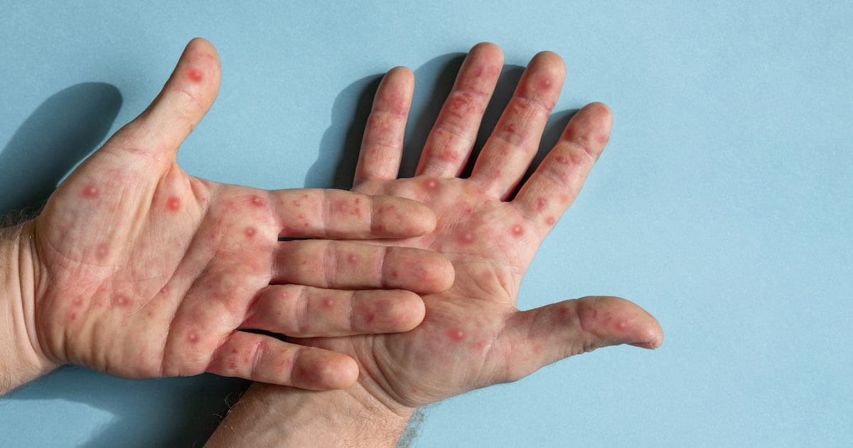 Segundo caso de nova cepa de mpox é confirmado no Estado de São Paulo