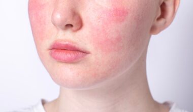 Rosácea tende a piorar com o avançar da idade; entenda os motivos e o que fazer