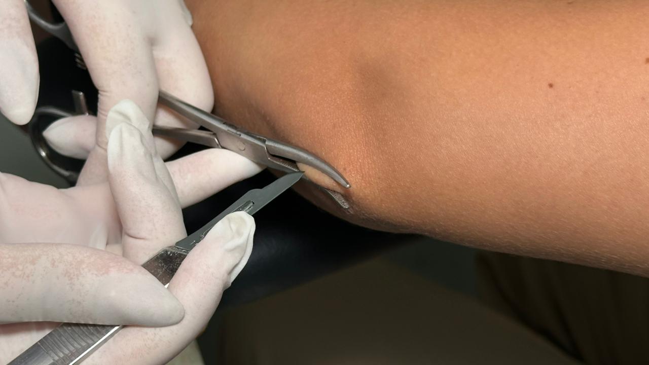 Janeiro Roxo reforça conscientização, diagnóstico precoce, combate ao preconceito e enfrentamento da hanseníase em Lagarto