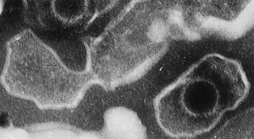 Estudo reforça suspeita que vírus Epstein-Barr pode causar esclerose múltipla