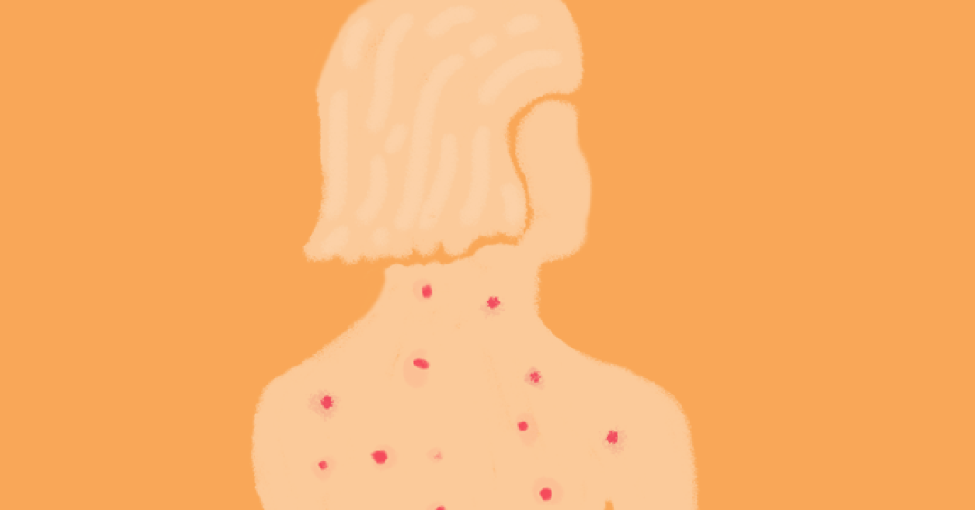 Governo barra vacina da herpes-zóster no SUS: saiba a quem é indicada e quanto custa na rede privada