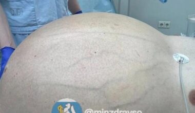 Médicos Russos Removem Tumor de 60 Kg Após 20 Anos em Paciente