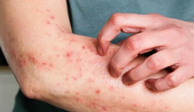 Mpox: o que é mito e o que é verdade segundo especialistas