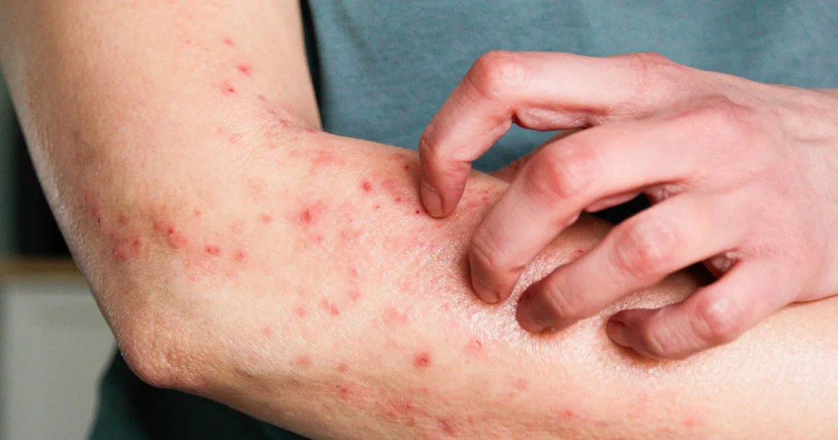 Mpox: o que é mito e o que é verdade segundo especialistas