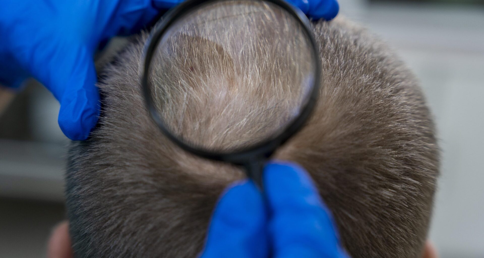 Câncer de pele pode atingir couro cabeludo