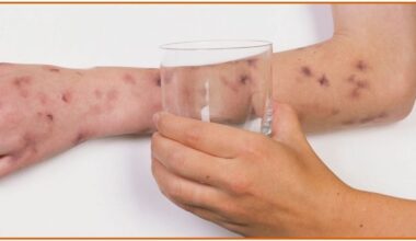 União dos Palmares registra caso de meningite B; saiba o que é, sintomas e como tratar - G1