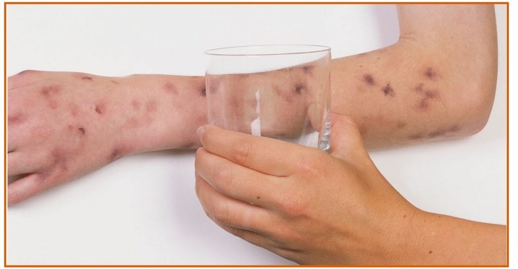 União dos Palmares registra caso de meningite B; saiba o que é, sintomas e como tratar - G1