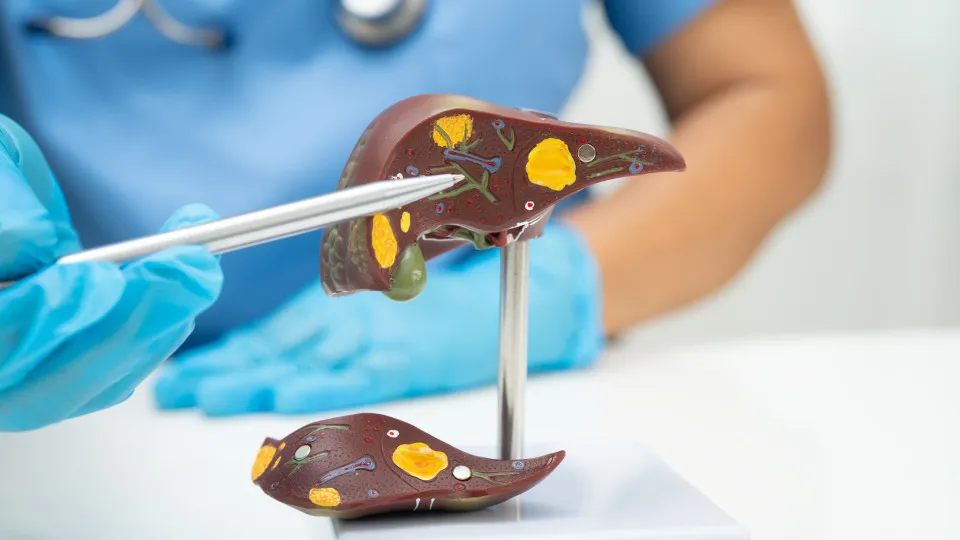 O tipo de dieta que pode aumentar risco de cancro do fígado