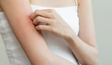 Comichão poderá ser sintoma de 5 tipos de cancro, alerta oncologista