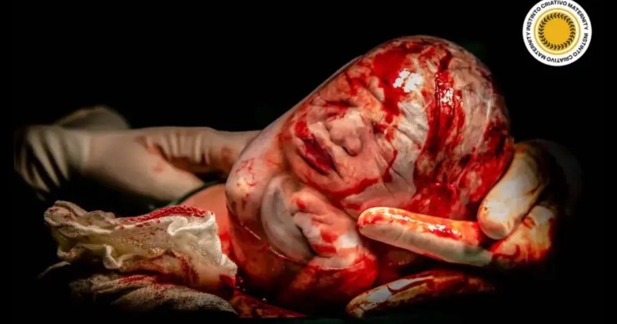 Bebê empelicado: fotógrafa mineira recebe maior média em concurso de fotografia sobre parto