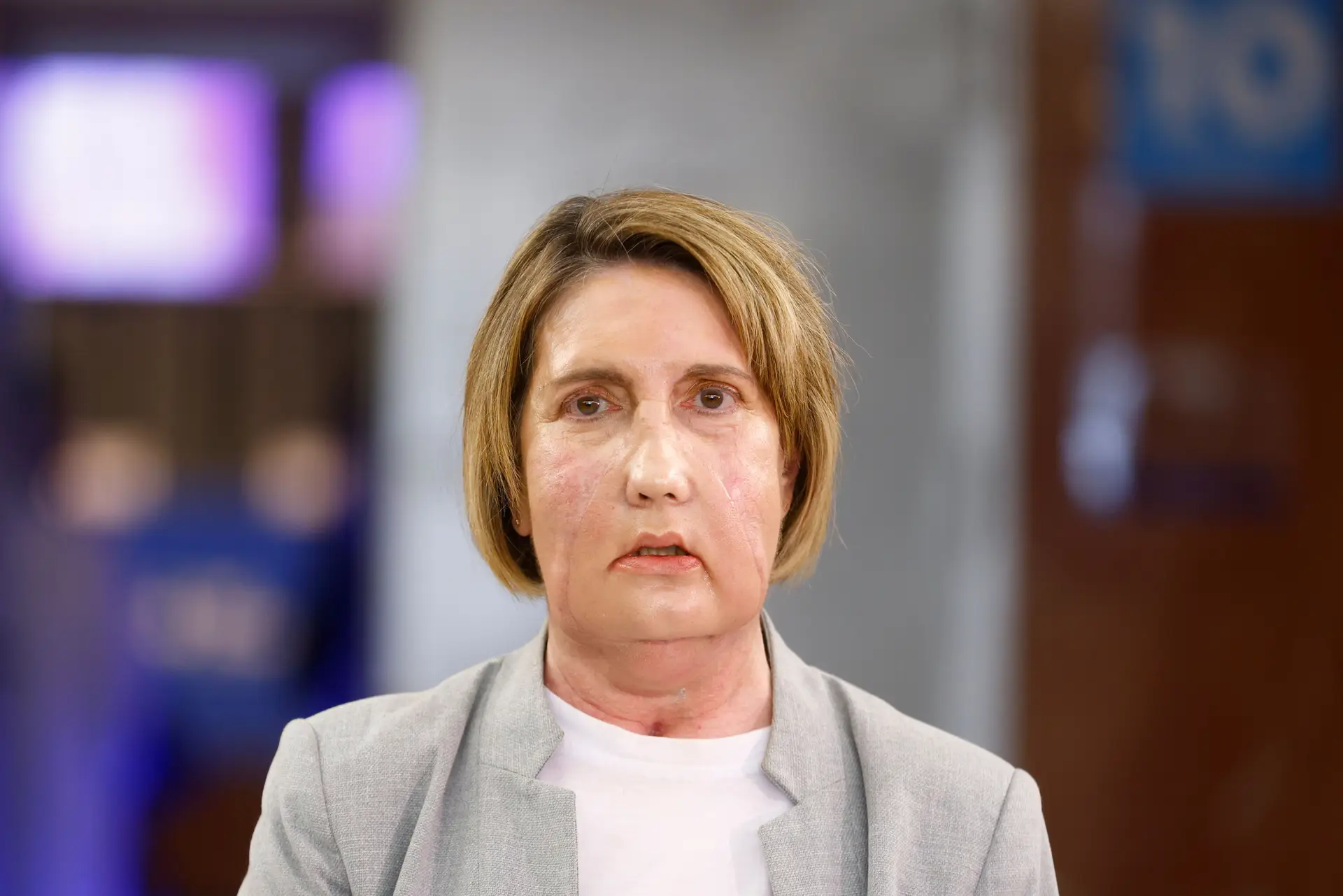 Carmen recebeu um transplante de cara