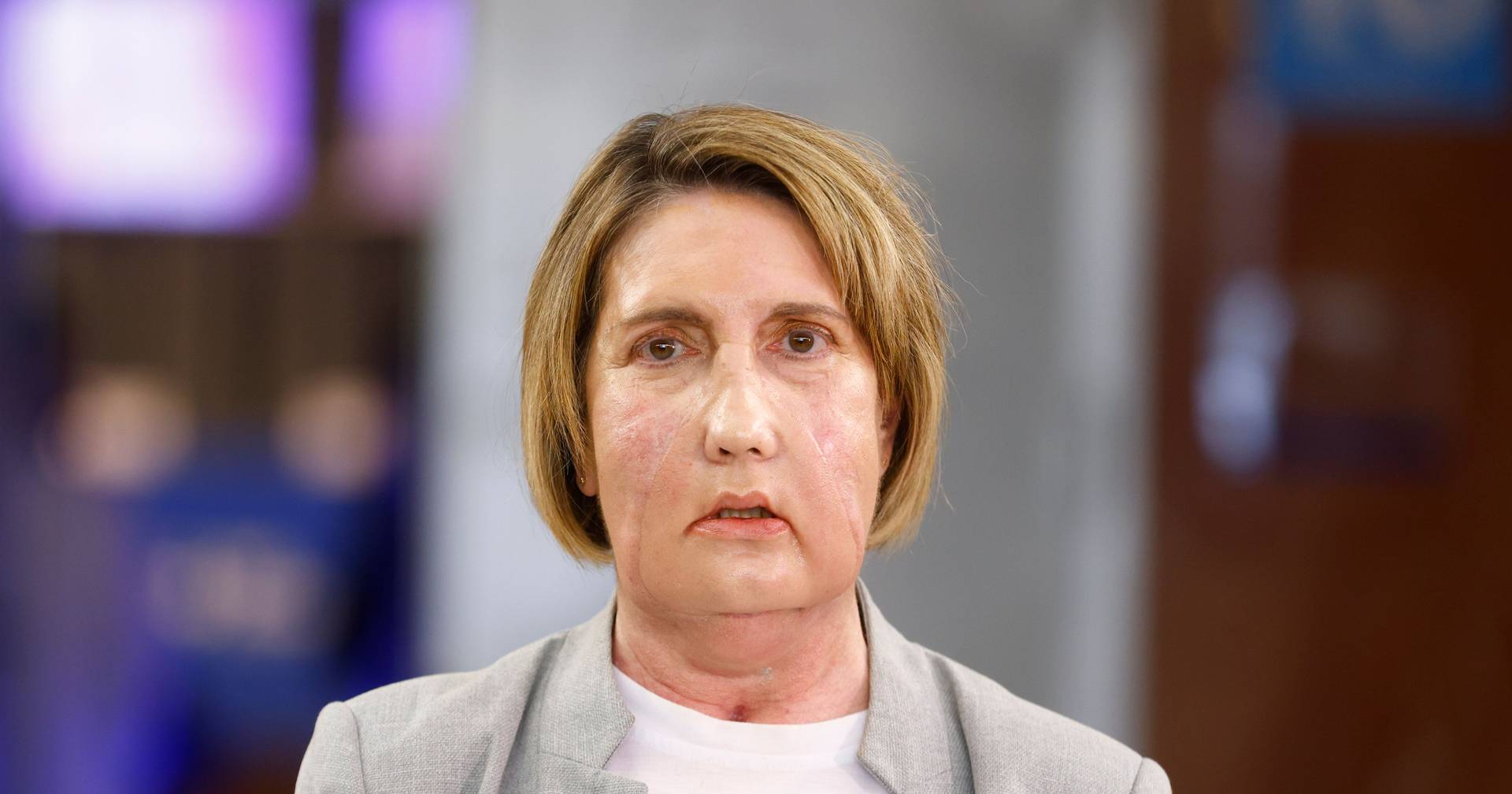 Hospital espanhol faz transplante de cara de doadora que pediu eutanásia pela primeira vez no mundo