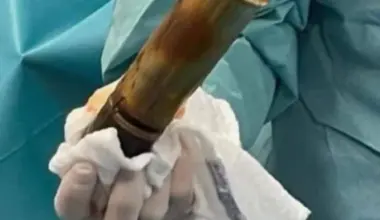 Homem vai a hospital com explosivo no ânus