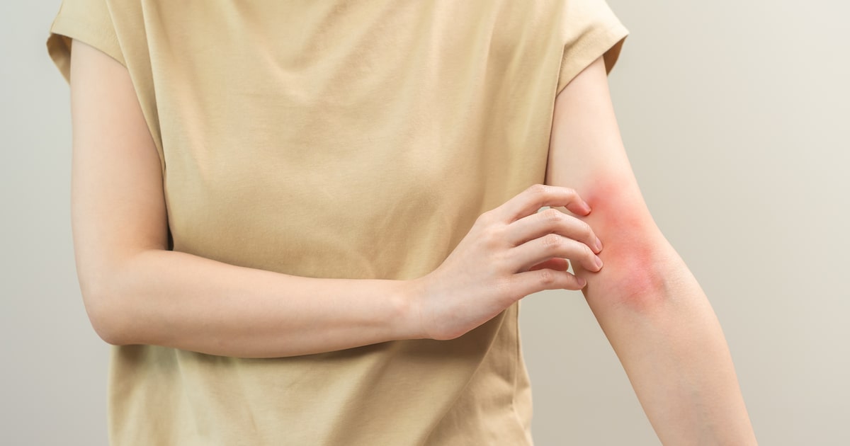 Dermatite não é tudo igual: conheça os principais tipos e saiba diferenciá-los