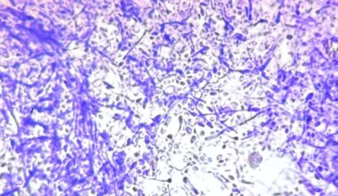 O ciupercă mortală se raspândește și face ravagii în spitalele din Europa. Ce se știe până acum despre ea