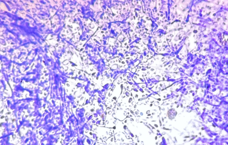 O ciupercă mortală se raspândește și face ravagii în spitalele din Europa. Ce se știe până acum despre ea