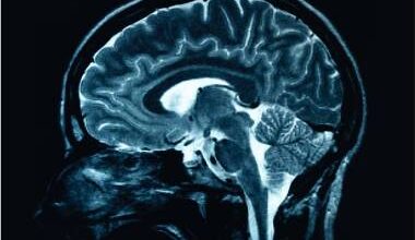 Creierul bărbaţilor se micşorează mai rapid decât al femeilor, arată un nou studiu despre Alzheimer