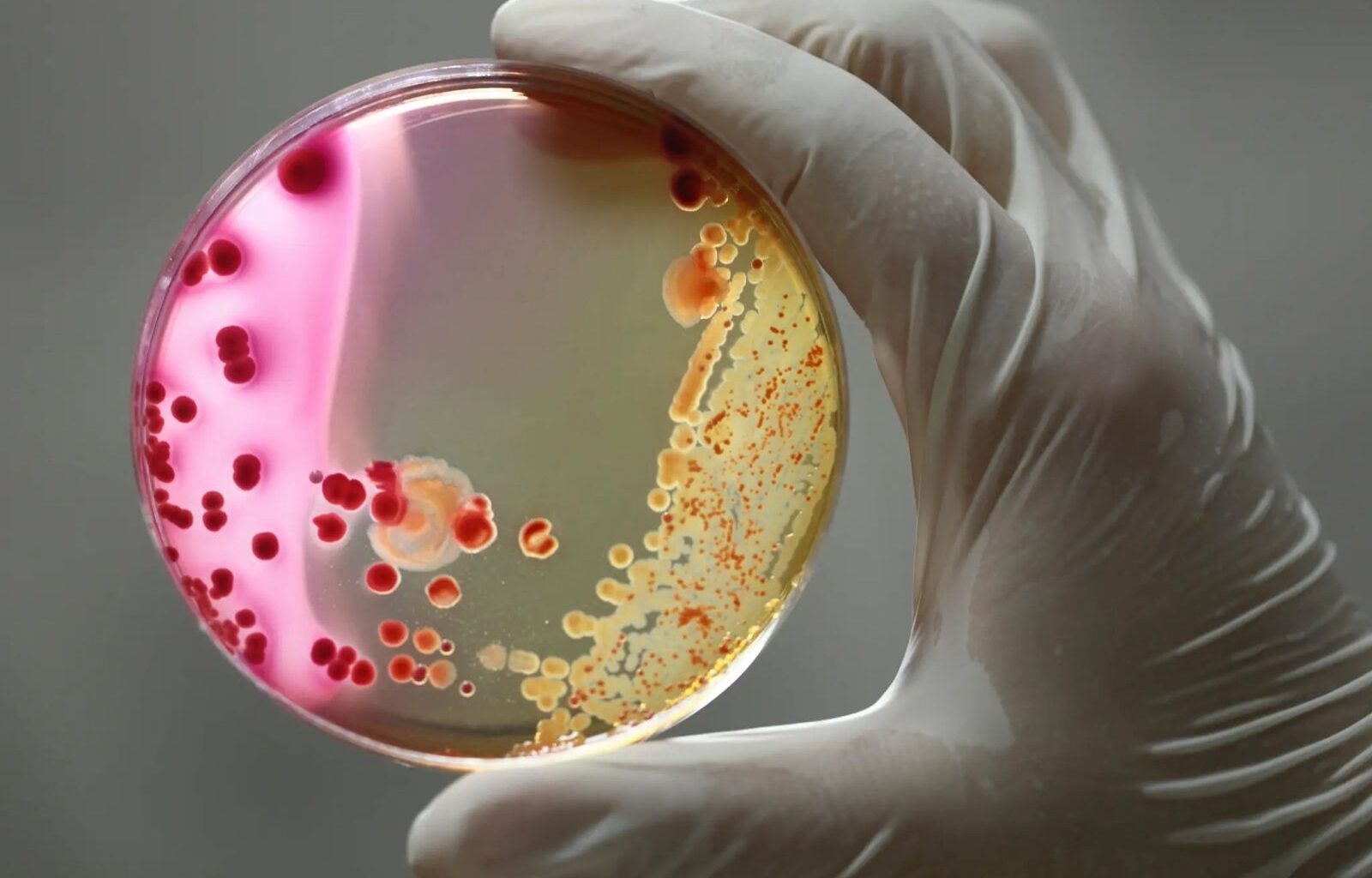 Bacteriile devin tot mai puternice, iar antibioticele tot mai slabe. Una din șase infecții bacteriene este rezistentă la tratament