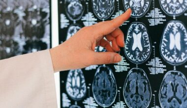 STUDIU Dieta ketogenică bogată în grasimi dar săracă în carbohidrați ar putea proteja sănătatea creierului şi încetini declinul cognitiv