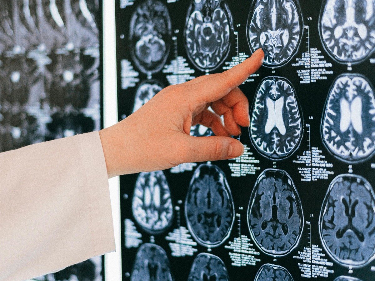 STUDIU Dieta ketogenică bogată în grasimi dar săracă în carbohidrați ar putea proteja sănătatea creierului şi încetini declinul cognitiv