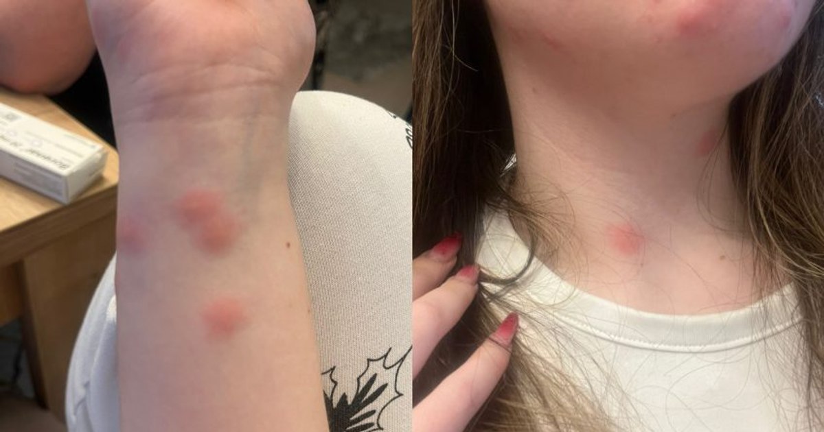 Călătorie de coșmar în trenul CFR: o tânără a ajuns la spital după ce a fost mușcată de ploșnițe