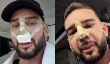 Cum arată nasul lui Dorian Popa la 12 zile de la operație. Și-a dat bandajul jos: „Cum nici nu am visat”