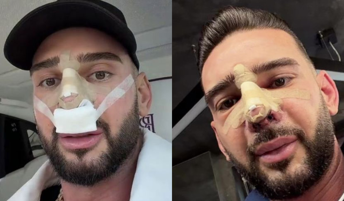 Cum arată nasul lui Dorian Popa la 12 zile de la operație. Și-a dat bandajul jos: „Cum nici nu am visat”