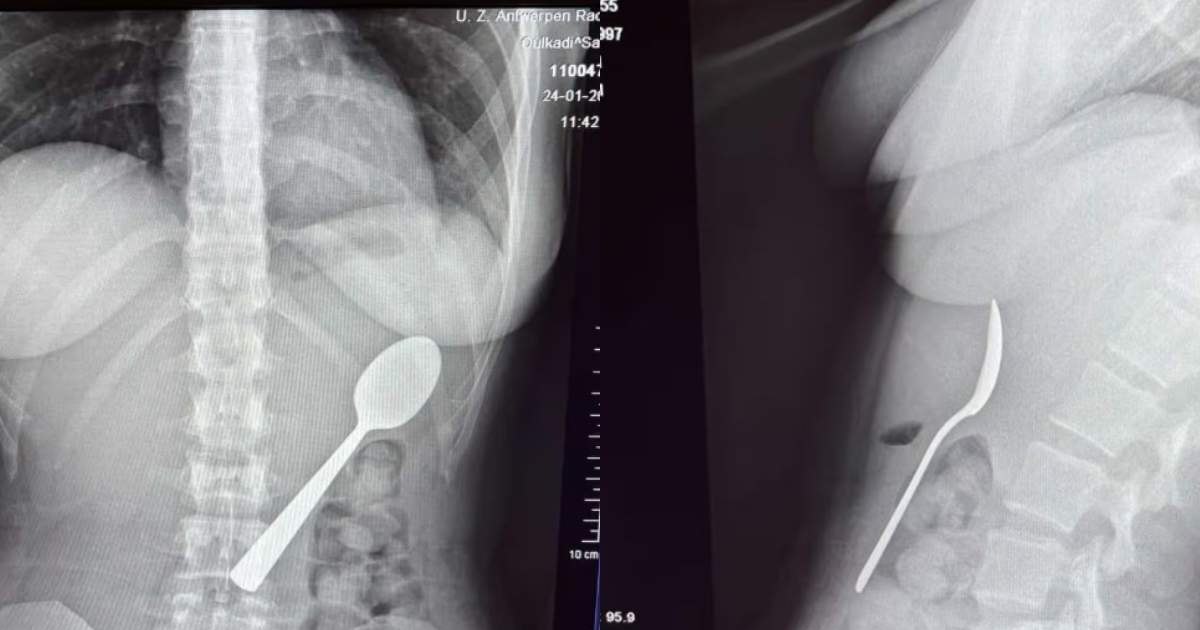 O tânără a înghițit o lingură de 17 cm din cauza câinelui: „Fie înghițeam, fie mă sufocam”