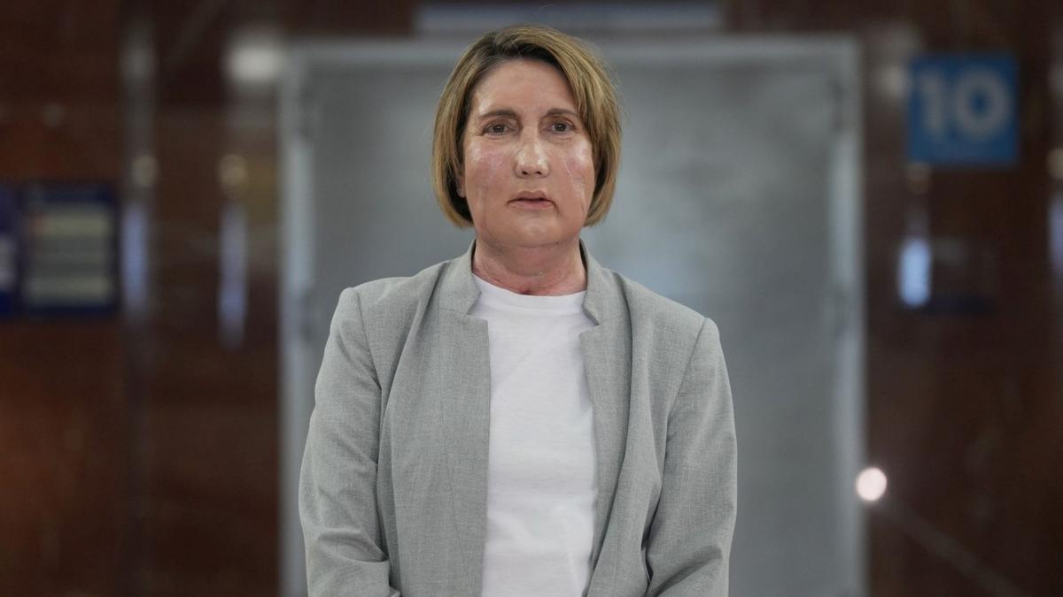 primul transplant facial de la o persoana decedata prin eutanasie spital barcelona