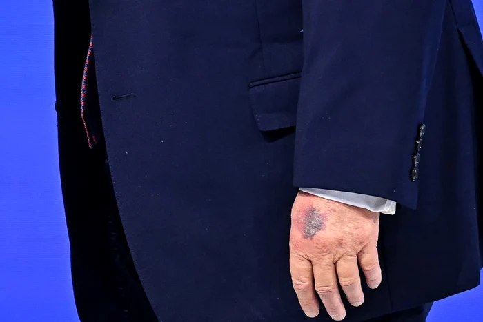 Donald Trump, la Davos. Președintele american avea o vânătaie pe mână. FOTO AFP