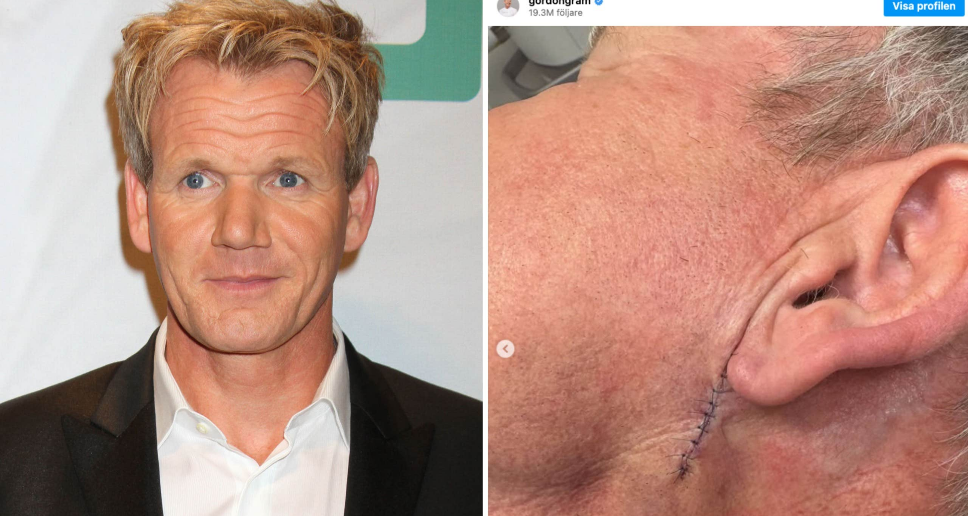 Gordon Ramsey har opererats för hudcancer