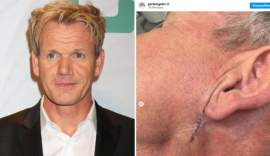 Gordon Ramsey har opererats för hudcancer