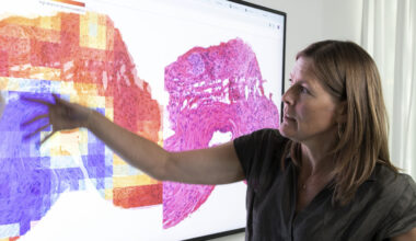 AI hittar missad prostatacancer - LäkemedelsVärlden