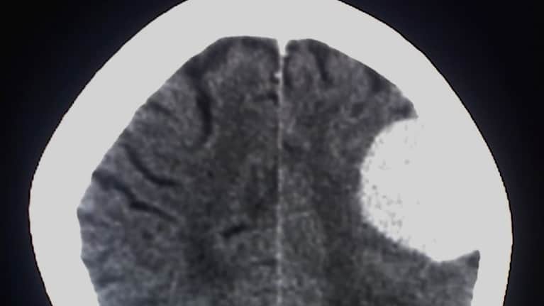 En svartvit datortomografibild av en hjärna med en tydlig tumör till höger.