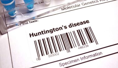 Genterapi saktar ner Huntingtons sjukdom med 75%