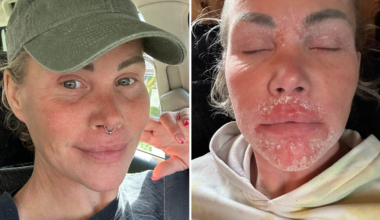Ellie, 40, lider av svåra atopiska eksem – behandlingen som hjälpt