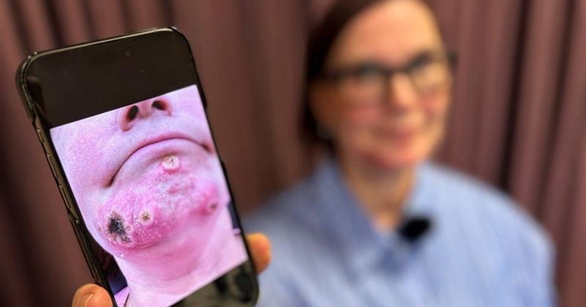 Åsa från Falun smittades med kokoppor av sin katt: ”Tänkte att det var en finne”