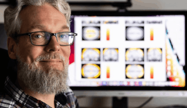 MS-experten: Fler borde få behandlingen i Sverige