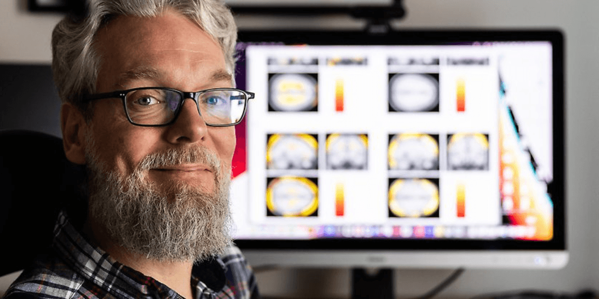 MS-experten: Fler borde få behandlingen i Sverige