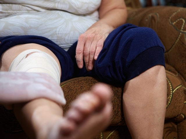 ”Vid artros finns en tydlig behandlingspyramid där den grundläggande behandlingen är patientutbildning, fysisk träning handledd av fysioterapeut samt vid behov viktminskning.”