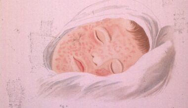 The vaccine has saved 94 million lives – but measles is spreading again