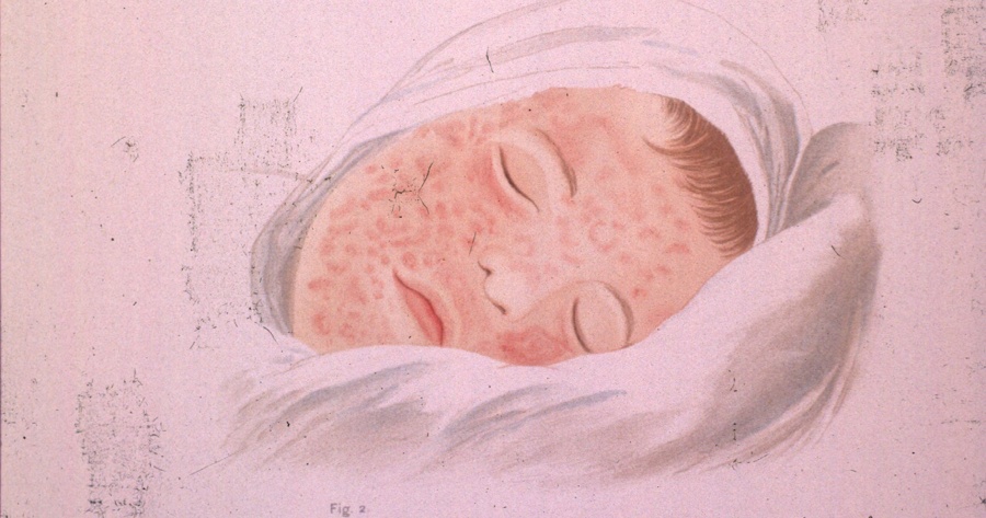 The vaccine has saved 94 million lives – but measles is spreading again