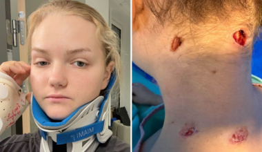 Svenska Naemi, 21, biten i nacken av lejon på safari i Sydafrika