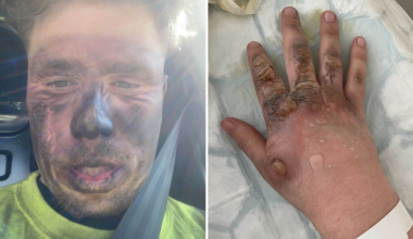 Rasmus, 21, fick 400 volt
 ”Var nära på att dö”