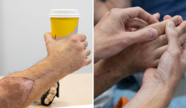 Patient fick två nya händer på Södersjukhuset i Stockholm