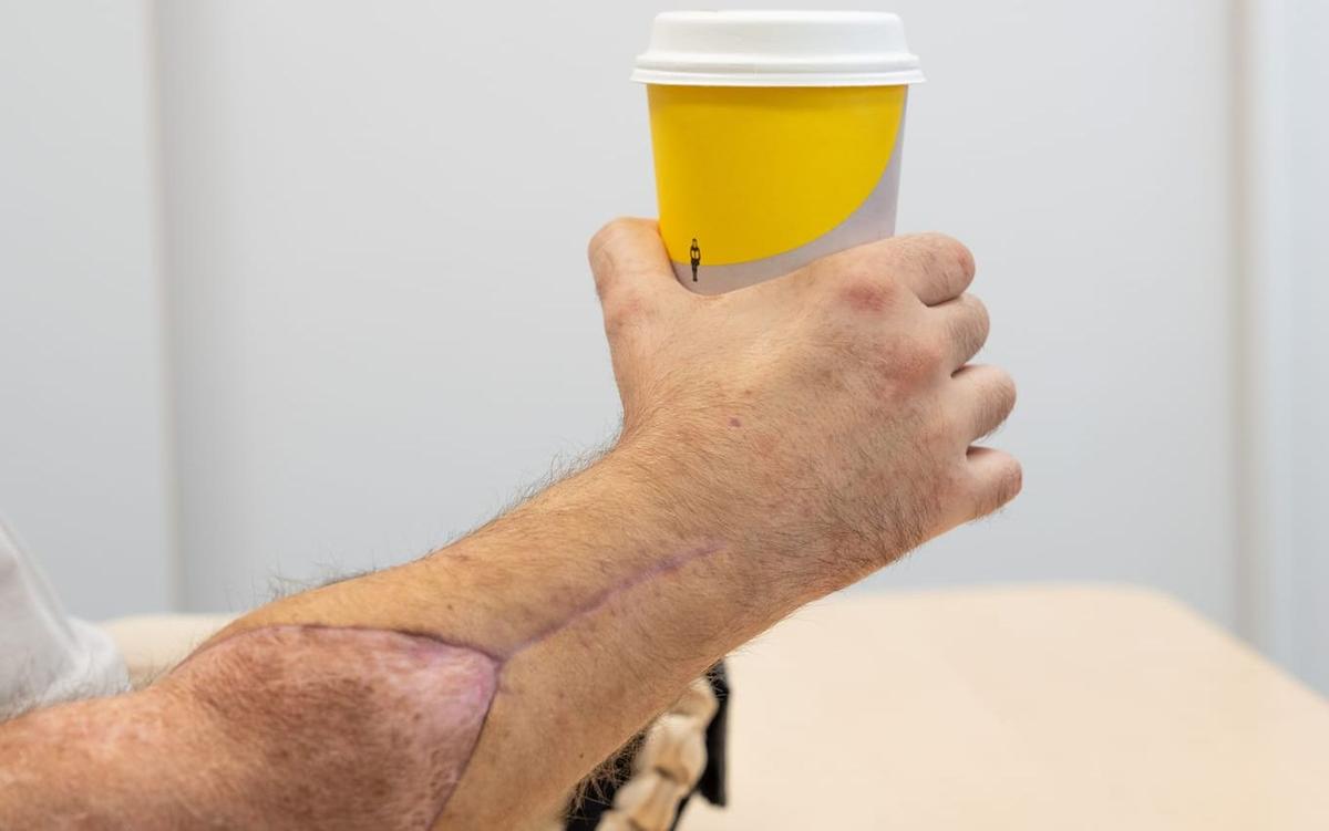 Fick två nya händer i somras – äter med bestick