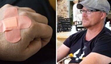 Mikael lider av den okända diagnosen ”skin picking”